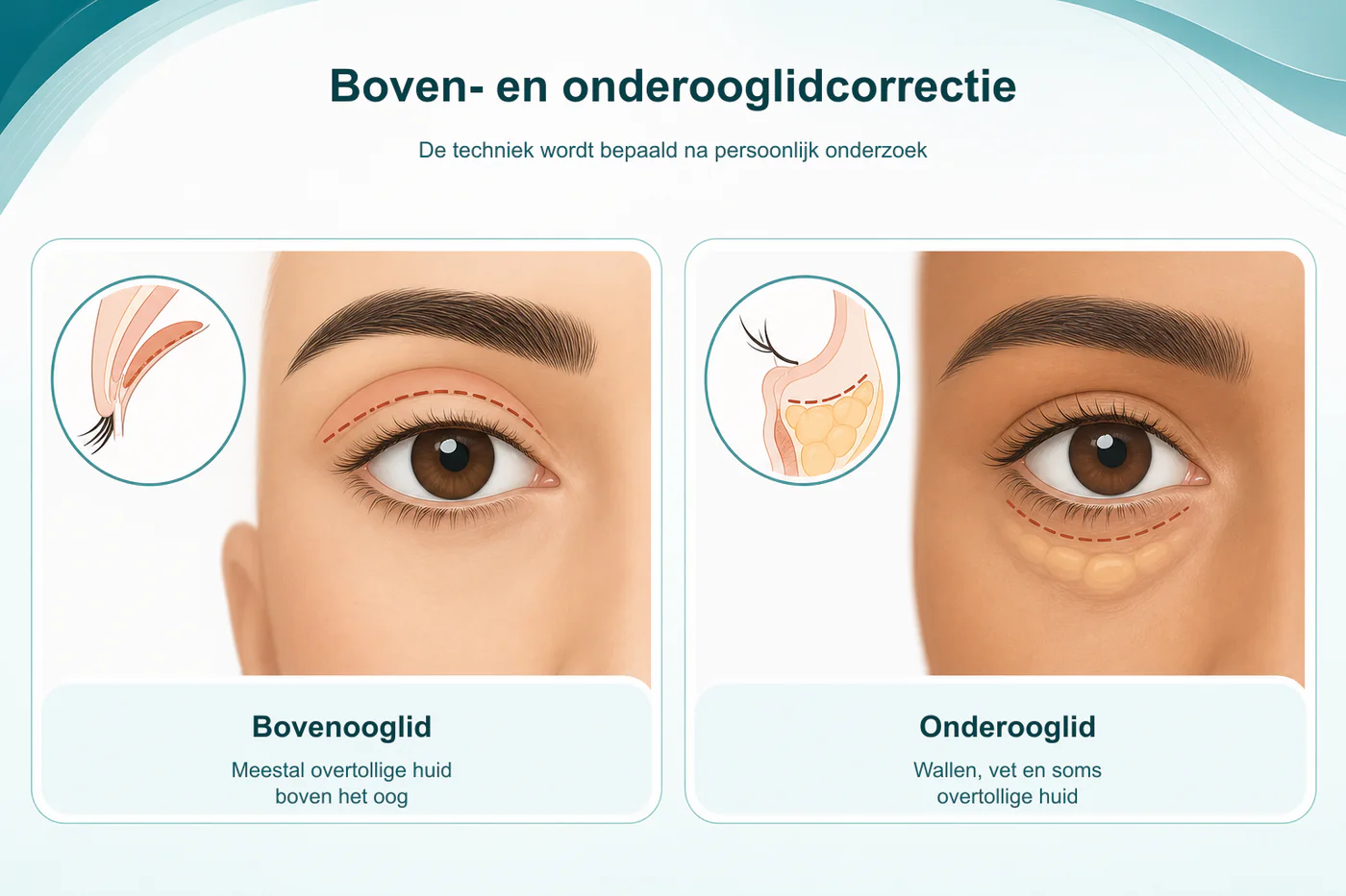 Infographic met vergelijking tussen een boven- en onderooglidcorrectie